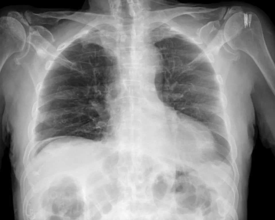 Perforacja jelita grubego objawy: niebagatelne sygnały, które mogą zagrażać zdrowiu