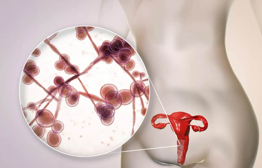 Leczenie Candidy: efektywne metody i praktyczne wskazówki