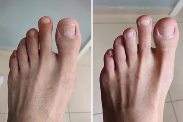 Pedicure podologiczny - więcej niż pielęgnacja. Dlaczego warto go wykonać?