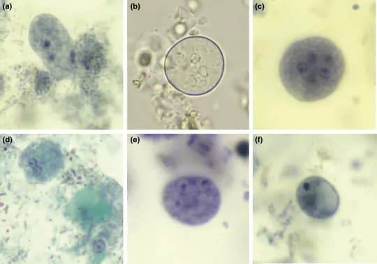 Entamoeba histolytica vs Endolimax nana: Objawy, leczenie