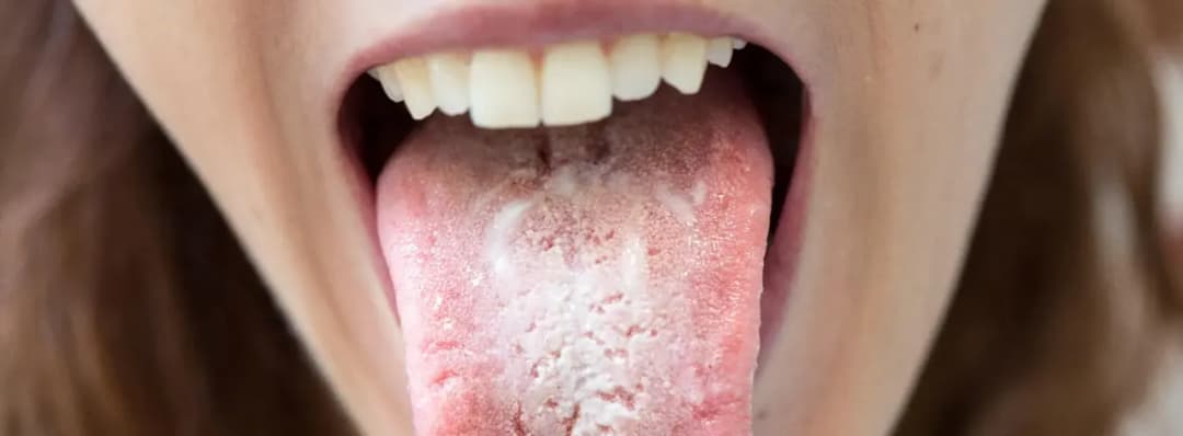 Candida u dzieci - objawy zakażenia grzybiczego i leczenie