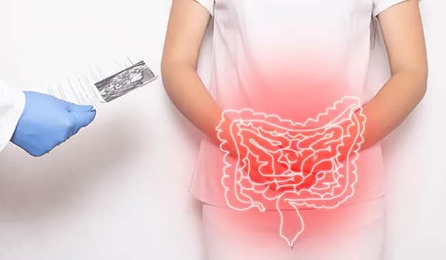 Jak leczyć zapalenie jelita grubego - skuteczne metody i porady