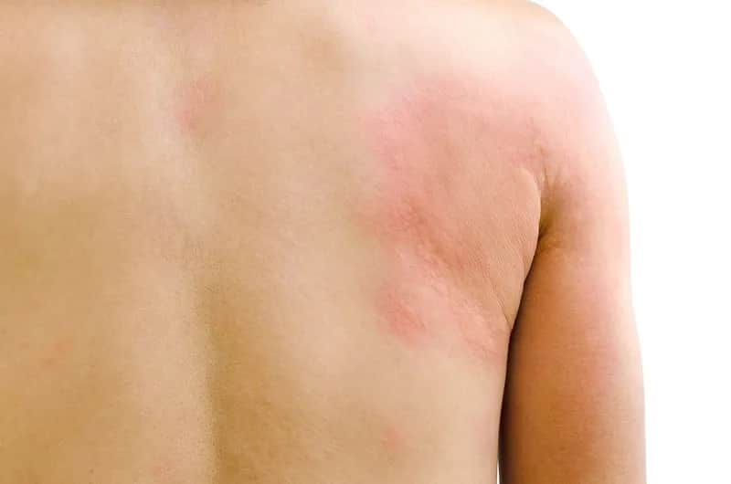 Toczeń: 5 wczesnych objawów, których nie wolno Ci zignorować