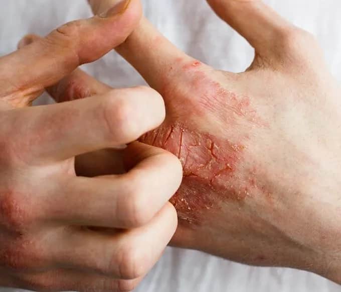 AZS i sarkoidoza - różnice między chorobami