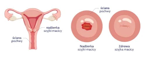 Obniżenie szyjki macicy objawy – jak rozpoznać niepokojące symptomy