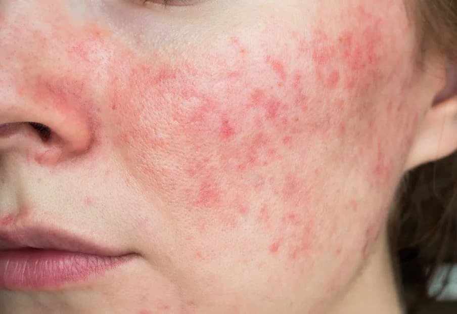 Trądzik różowaty przyczyny: Co wywołuje tę uciążliwą chorobę?