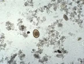 Tłuszcz w kale: Co oznacza i jak go rozpoznać? 6 ważnych wskazówek