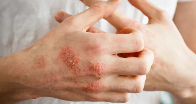 Nietolerancja glutenu: jakie objawy skórne mają znaczenie?