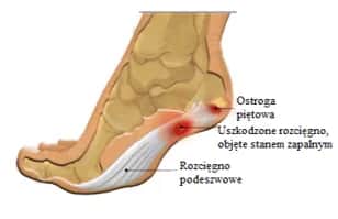 Ból pięty: poznaj przyczyny i skutki, które mogą cię zaskoczyć