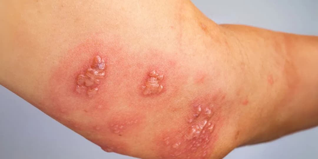 Wysypka od roztoczy: strategie radzenia sobie z problemem.