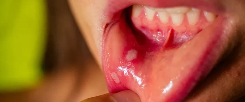 Skuteczne metody leczenia pleśniawek u 3-letniego dziecka