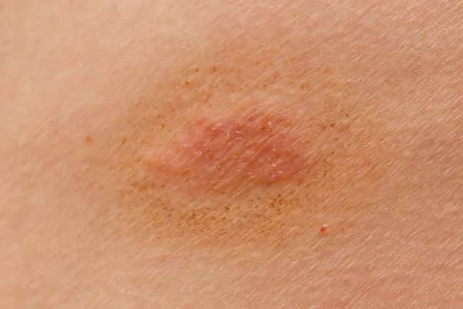 Grzybica jelit objawy skórne – jak rozpoznać i leczyć dolegliwości?