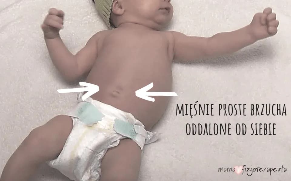 Rozejście mięśnia prostego brzucha u dziecka: objawy i leczenie.