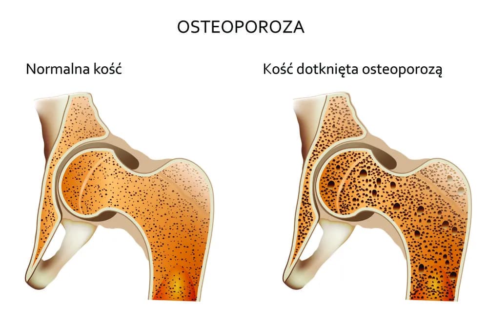 Osteoporoza przyczyny: Jak uniknąć utraty gęstości kości?