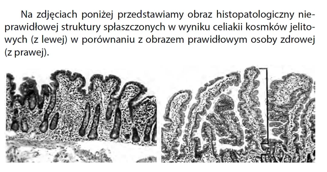 Celiakia - charakterystyczne objawy choroby trzewnej