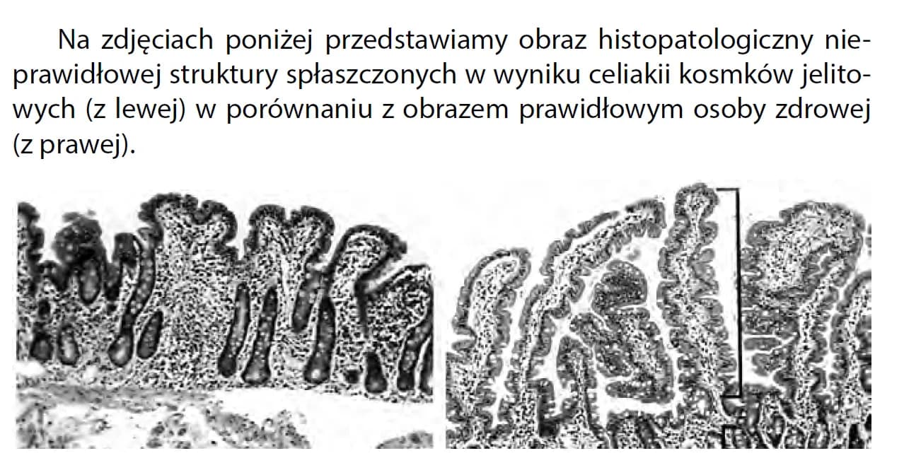 Celiakia - charakterystyczne objawy choroby trzewnej