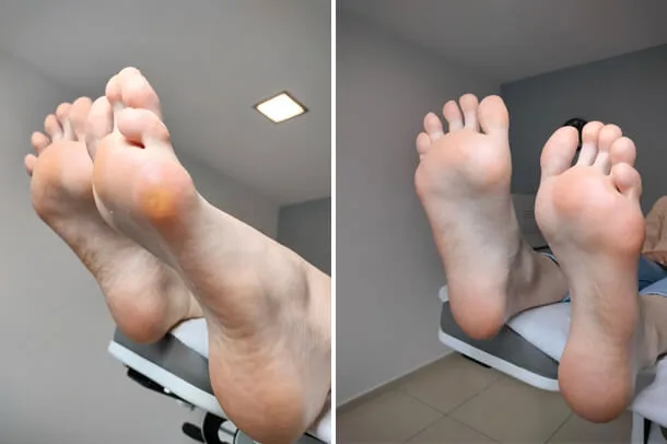 Łódź: Pedicure podologiczny Koniec z bólem stóp? Sprawdź!