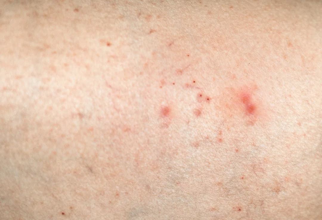 Atopowe zapalenie skóry u dorosłych – co warto wiedzieć?