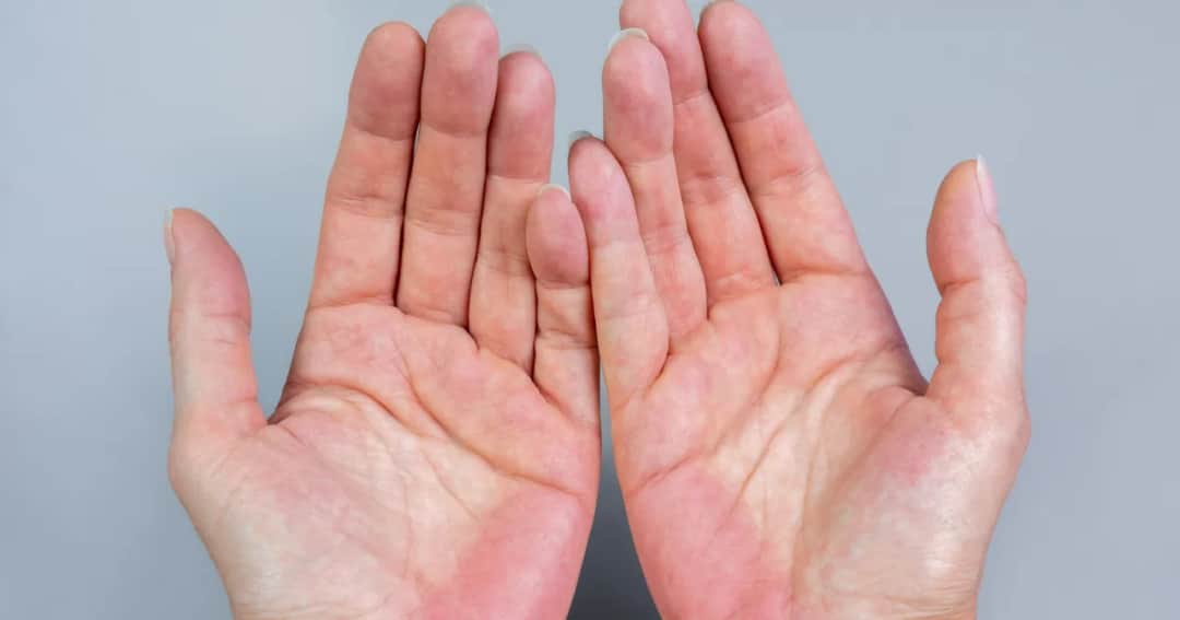 Czerwone dłonie od wewnątrz przyczyny: objawy, które mogą zaskoczyć