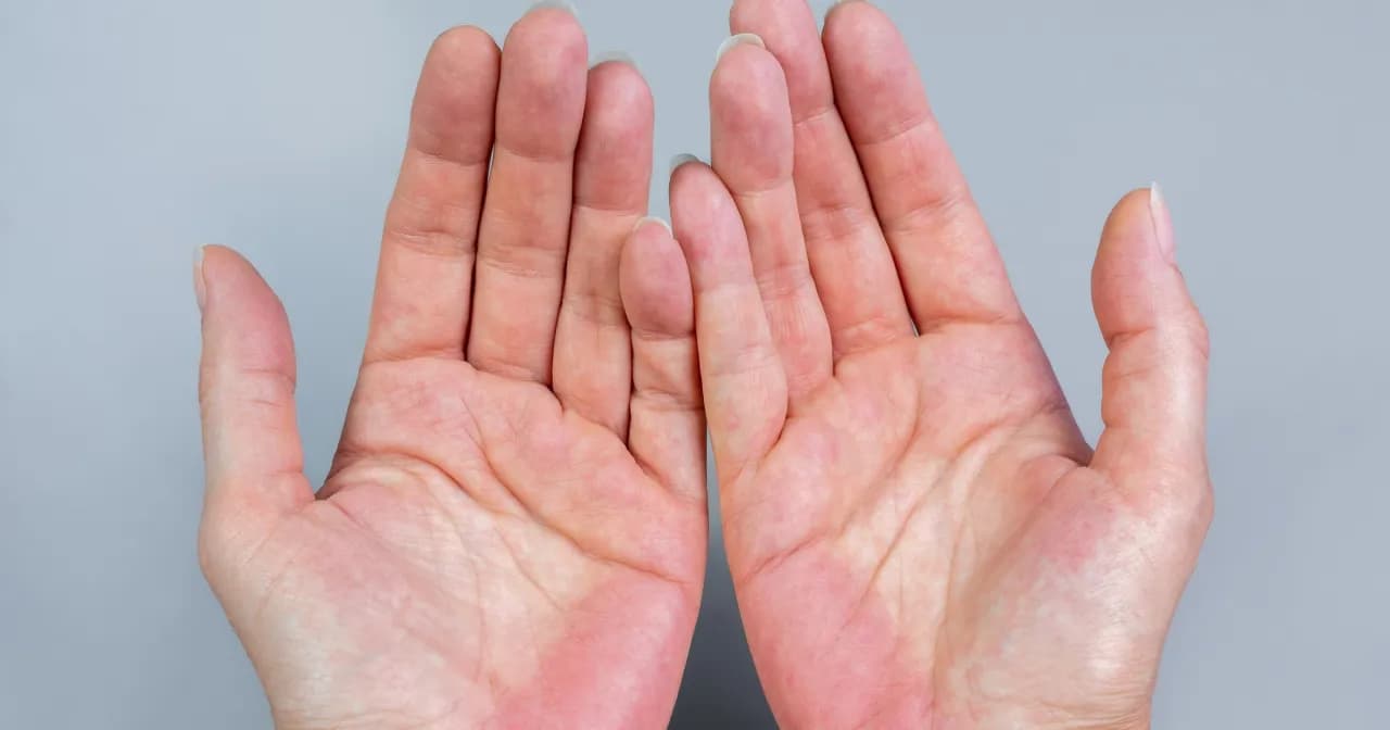 Czerwone dłonie od wewnątrz przyczyny: objawy, które mogą zaskoczyć