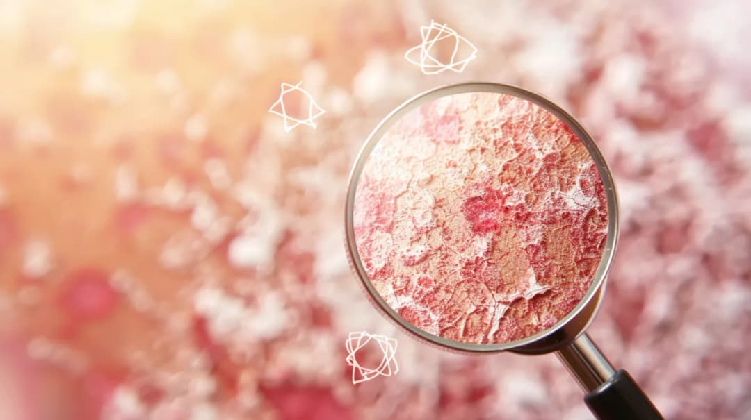 Początki łuszczycy: Jak wcześnie rozpoznać chorobę? Oto objawy