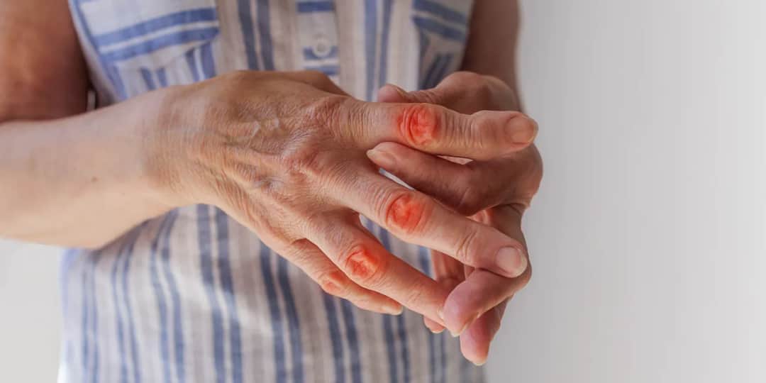 Obrzęk stawów: przyczyny i skuteczne metody w różnych przypadkach.