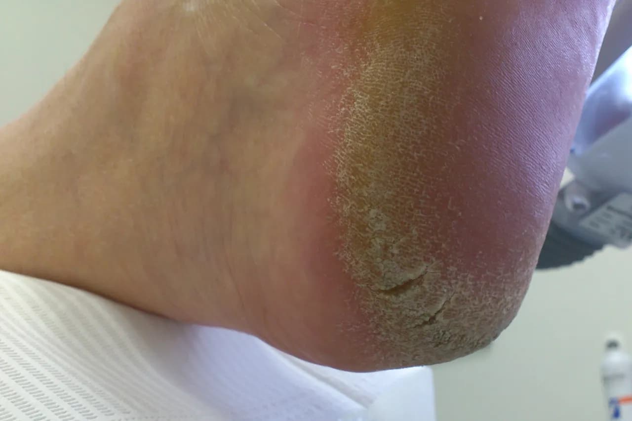 Pękające pięty: Odkryj przyczyny i skuteczne metody leczenia